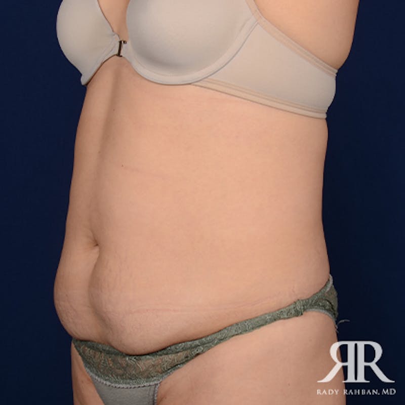 Tummy Tuck Before & After Gallery - Patient 275394 - Image 3