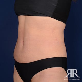 Tummy Tuck Before & After Gallery - Patient 275394 - Image 4