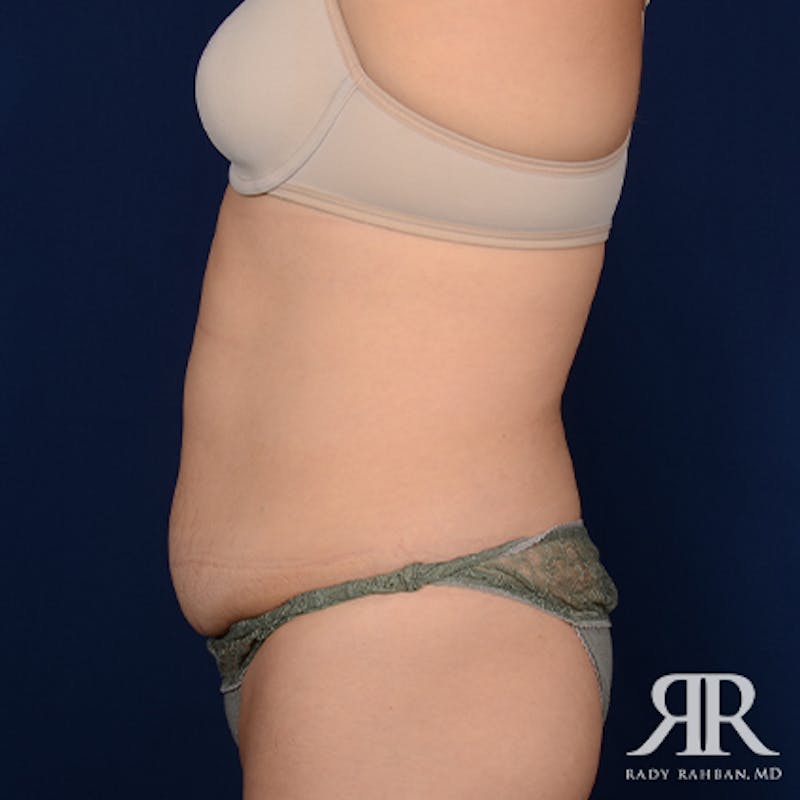 Tummy Tuck Before & After Gallery - Patient 275394 - Image 5