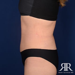 Tummy Tuck Before & After Gallery - Patient 275394 - Image 6