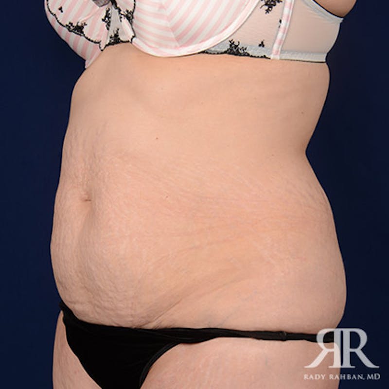 Tummy Tuck Before & After Gallery - Patient 277450 - Image 3