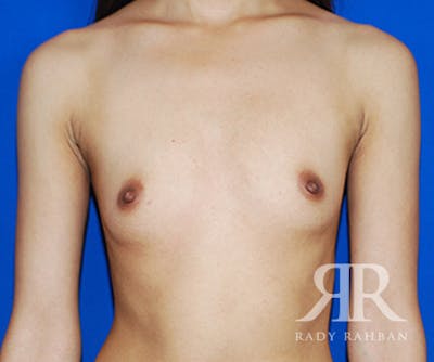 Breast Augmentation Before & After Gallery - Patient 104677 - Image 1