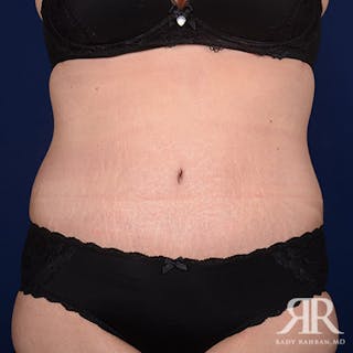 Tummy Tuck Before & After Gallery - Patient 270763 - Image 2