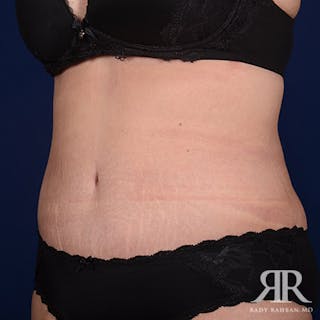 Tummy Tuck Before & After Gallery - Patient 270763 - Image 4