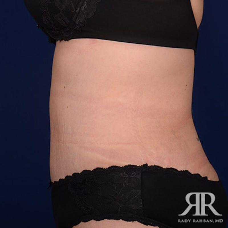 Tummy Tuck Before & After Gallery - Patient 270763 - Image 6