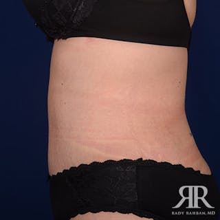 Tummy Tuck Before & After Gallery - Patient 270763 - Image 6