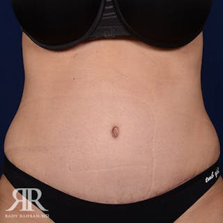 Tummy Tuck Before & After Gallery - Patient 358173 - Image 2