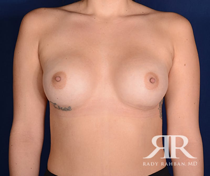 Breast Augmentation Before & After Gallery - Patient 299410 - Image 2