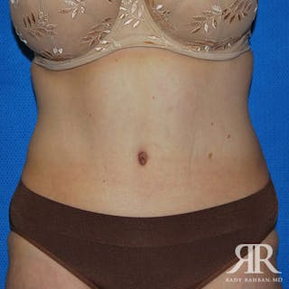Tummy Tuck Before & After Gallery - Patient 241028 - Image 2