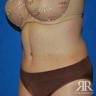 Tummy Tuck Before & After Gallery - Patient 241028 - Image 4
