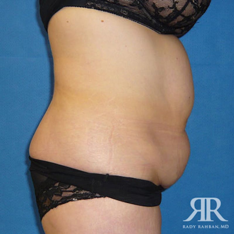 Tummy Tuck Before & After Gallery - Patient 241028 - Image 5