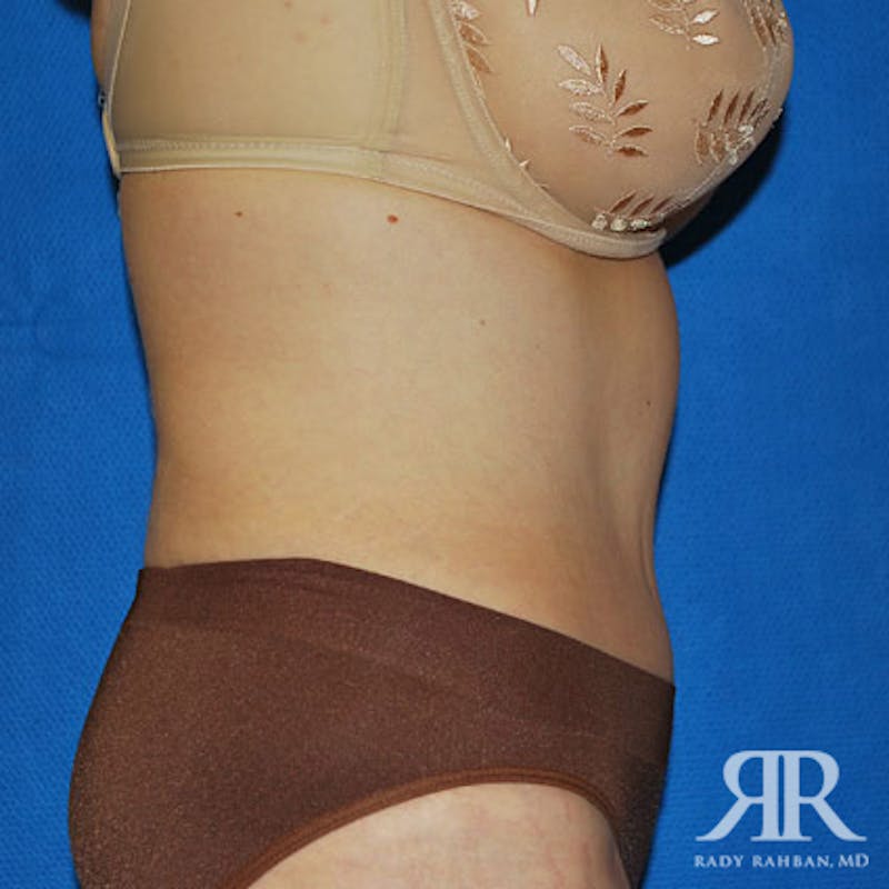 Tummy Tuck Before & After Gallery - Patient 241028 - Image 6