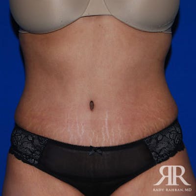 Tummy Tuck Before & After Gallery - Patient 369216 - Image 2