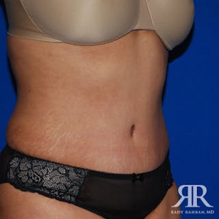 Tummy Tuck Before & After Gallery - Patient 369216 - Image 4