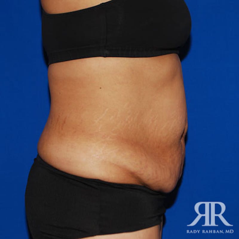 Tummy Tuck Before & After Gallery - Patient 369216 - Image 5