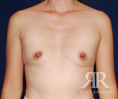 Breast Augmentation Before & After Gallery - Patient 304488 - Image 1