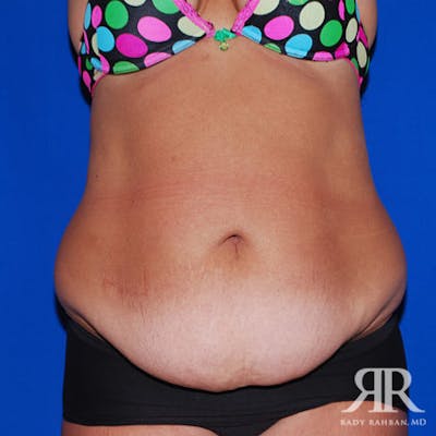 Tummy Tuck Before & After Gallery - Patient 329734 - Image 1