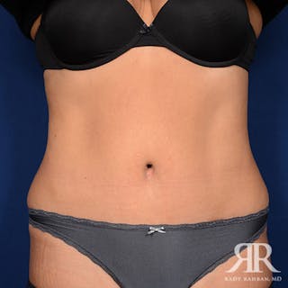 Tummy Tuck Before & After Gallery - Patient 329734 - Image 2