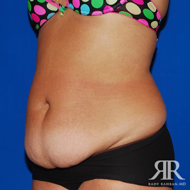 Tummy Tuck Before & After Gallery - Patient 329734 - Image 3