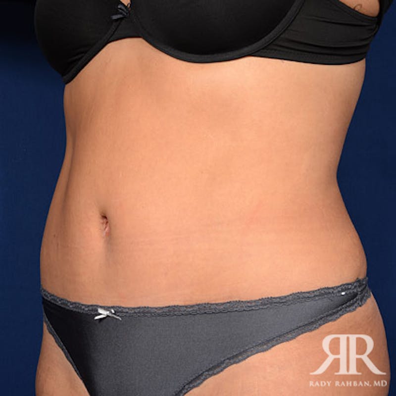 Tummy Tuck Before & After Gallery - Patient 329734 - Image 4