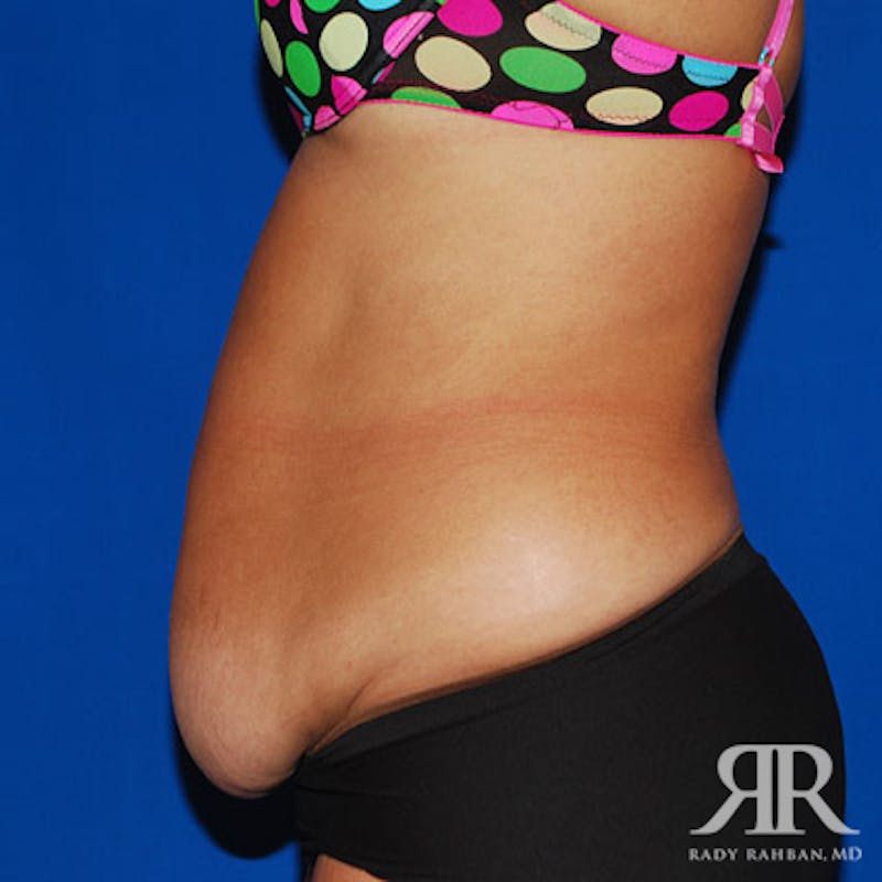 Tummy Tuck Before & After Gallery - Patient 329734 - Image 5