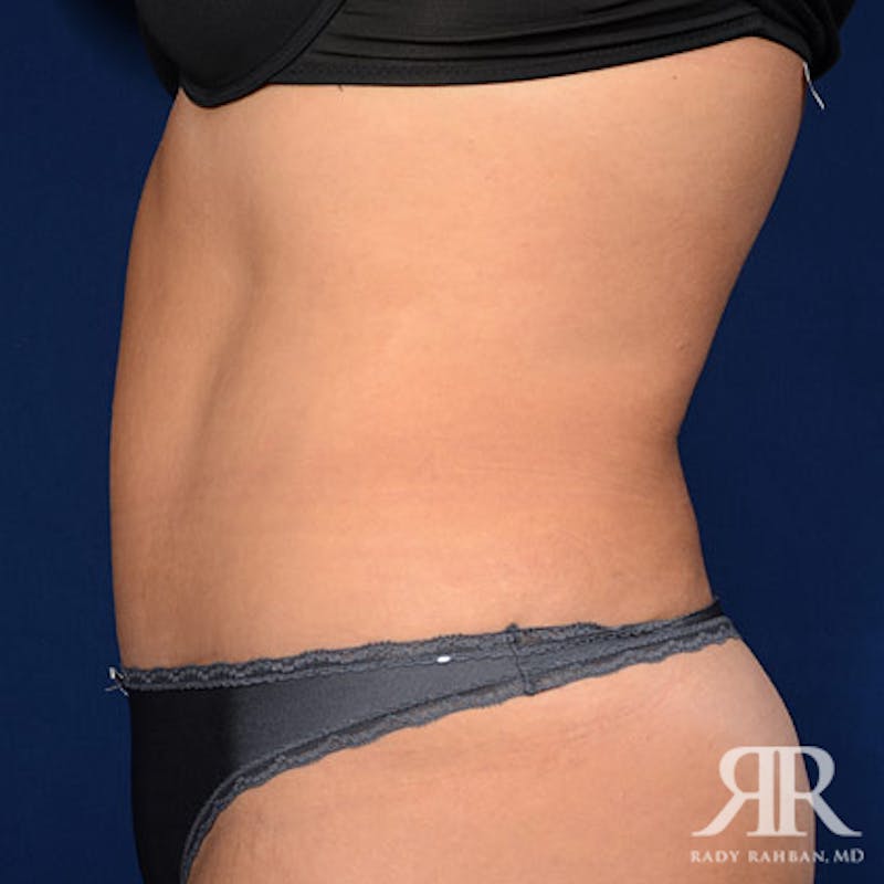 Tummy Tuck Before & After Gallery - Patient 329734 - Image 6