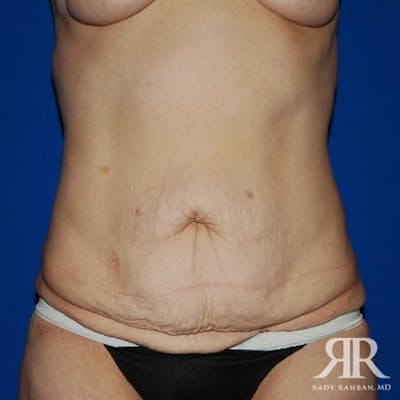 Tummy Tuck Before & After Gallery - Patient 133799 - Image 1