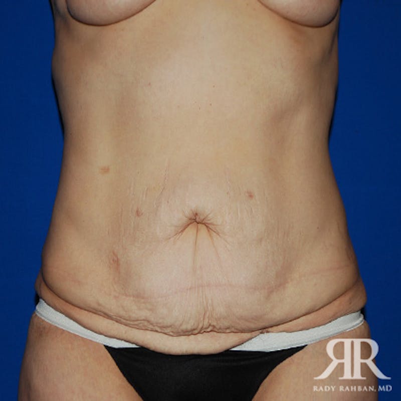 Tummy Tuck Before & After Gallery - Patient 133799 - Image 1