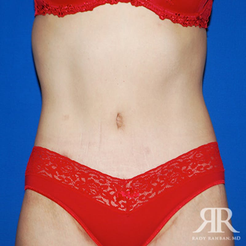 Tummy Tuck Before & After Gallery - Patient 133799 - Image 2