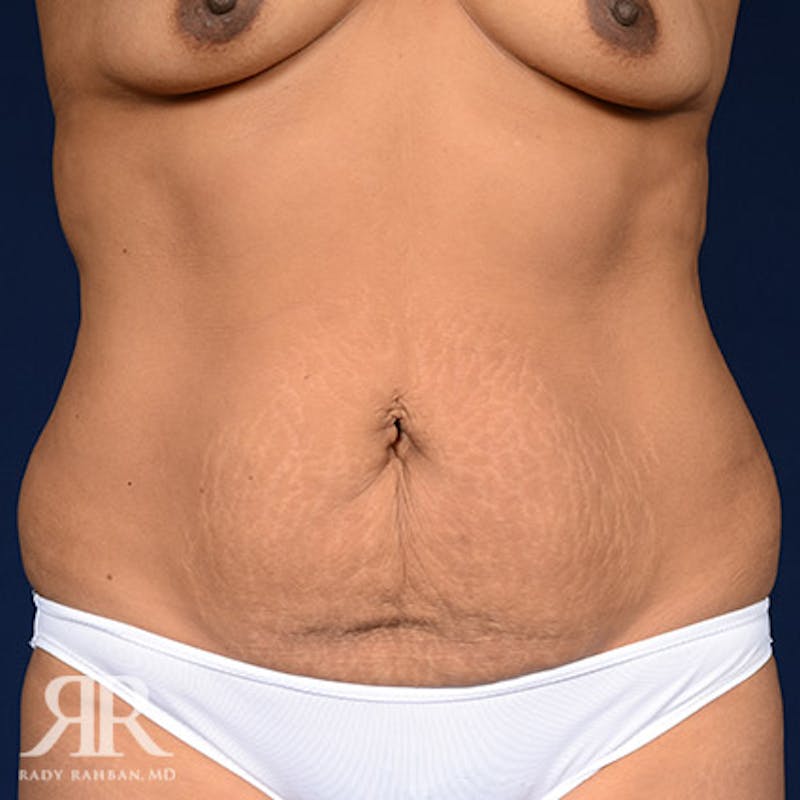 Tummy Tuck Before & After Gallery - Patient 279578 - Image 1