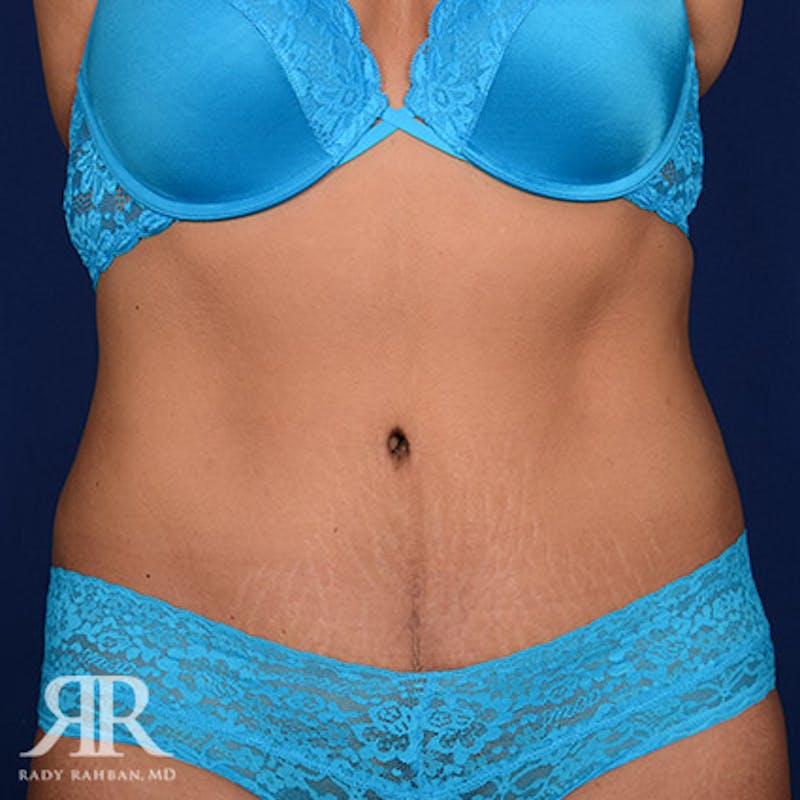 Tummy Tuck Before & After Gallery - Patient 279578 - Image 2
