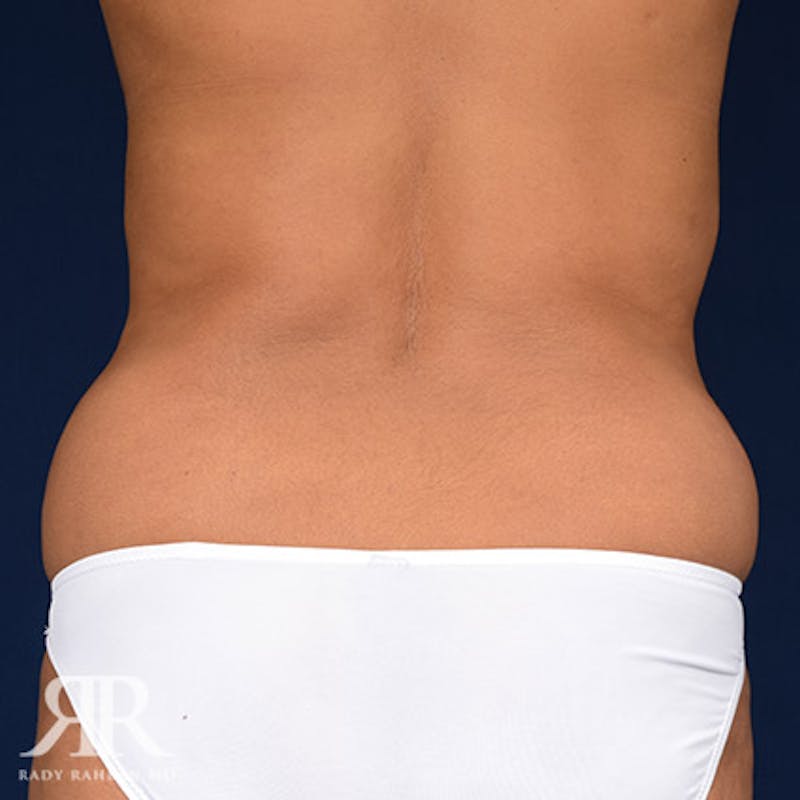 Tummy Tuck Before & After Gallery - Patient 279578 - Image 7