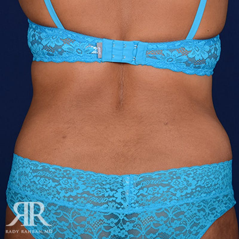 Tummy Tuck Before & After Gallery - Patient 279578 - Image 8