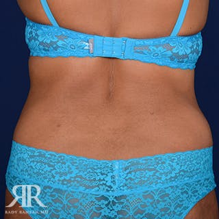 Tummy Tuck Before & After Gallery - Patient 279578 - Image 8