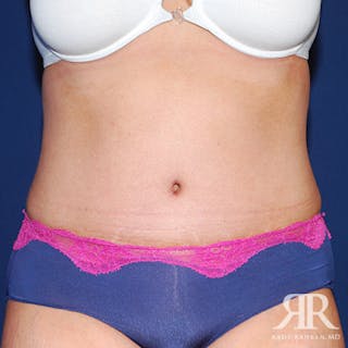 Tummy Tuck Before & After Gallery - Patient 149065 - Image 2