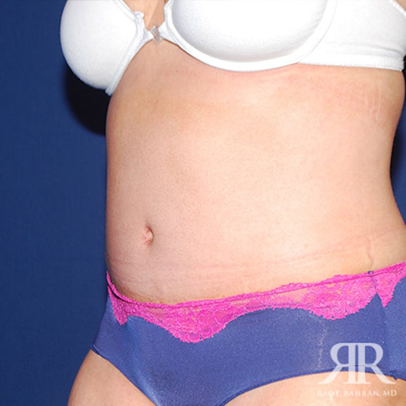 Tummy Tuck Before & After Gallery - Patient 149065 - Image 4