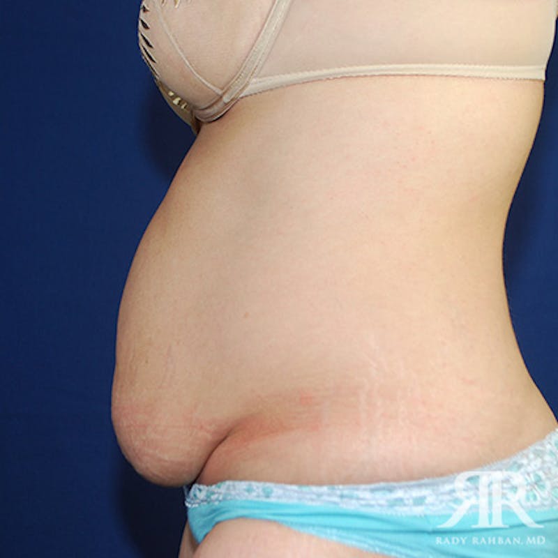 Tummy Tuck Before & After Gallery - Patient 149065 - Image 5