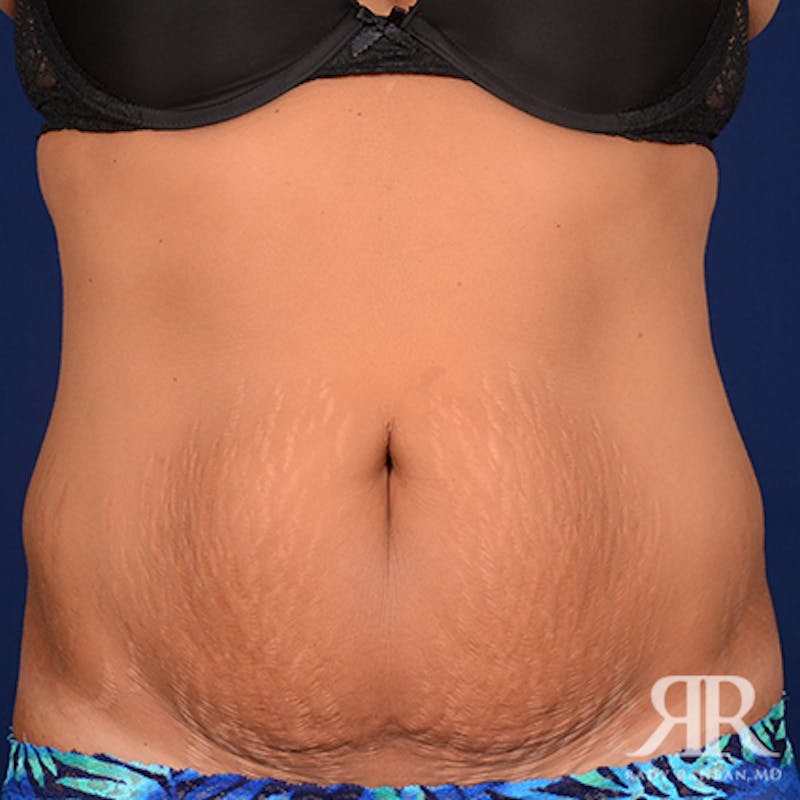 Tummy Tuck Before & After Gallery - Patient 469455 - Image 1
