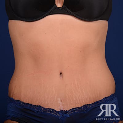 Tummy Tuck Before & After Gallery - Patient 469455 - Image 2