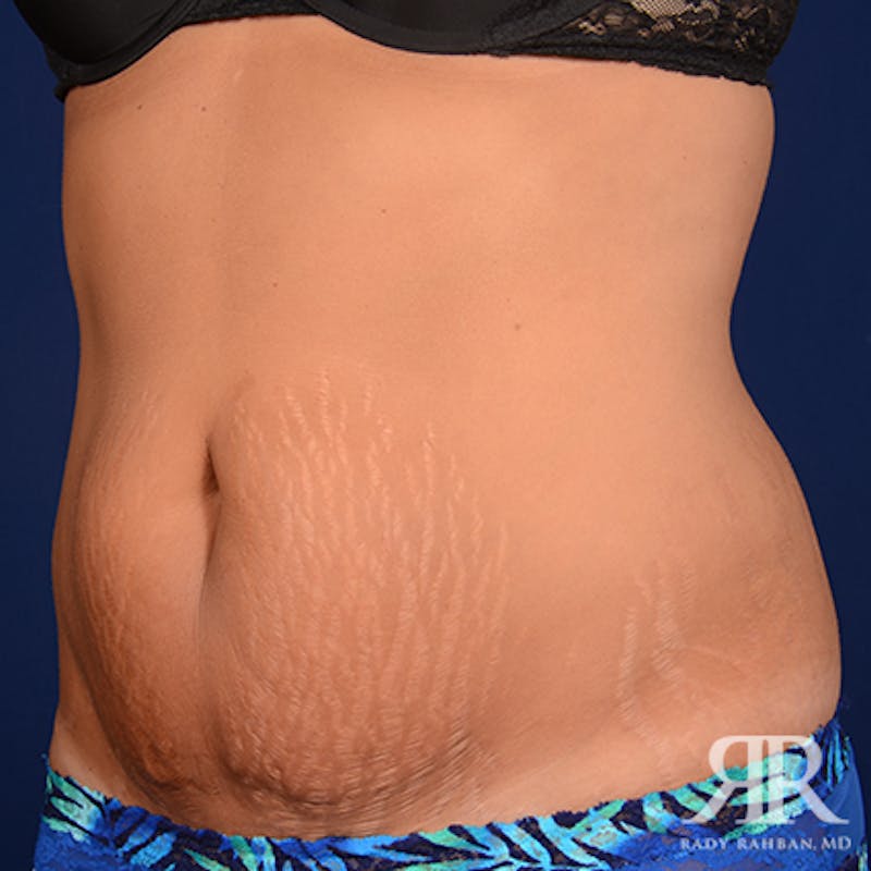 Tummy Tuck Before & After Gallery - Patient 469455 - Image 3