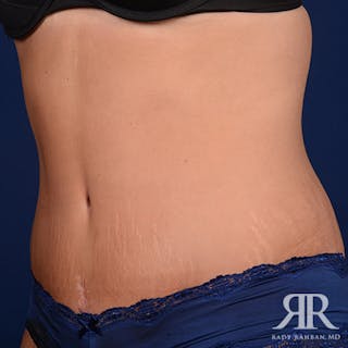 Tummy Tuck Before & After Gallery - Patient 469455 - Image 4