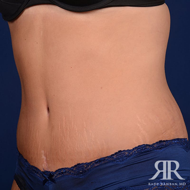 Tummy Tuck Before & After Gallery - Patient 469455 - Image 4