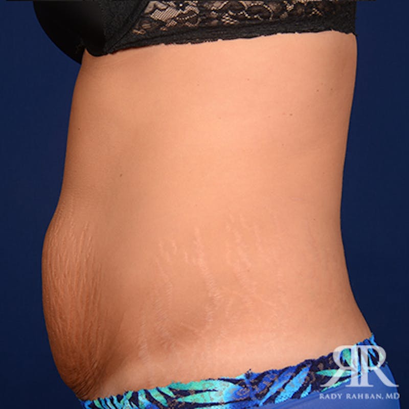 Tummy Tuck Before & After Gallery - Patient 469455 - Image 5