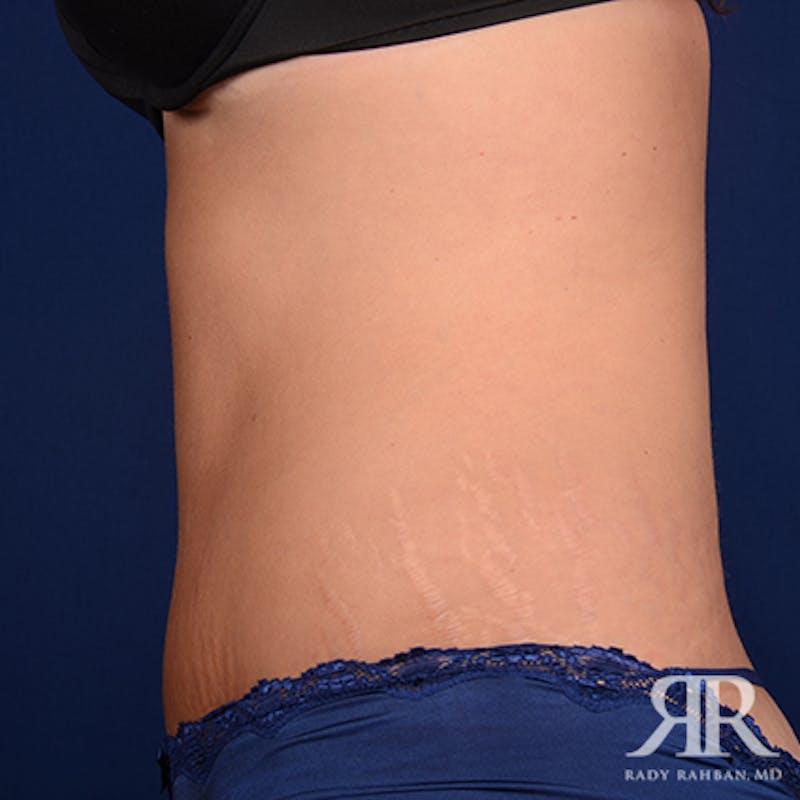 Tummy Tuck Before & After Gallery - Patient 469455 - Image 6