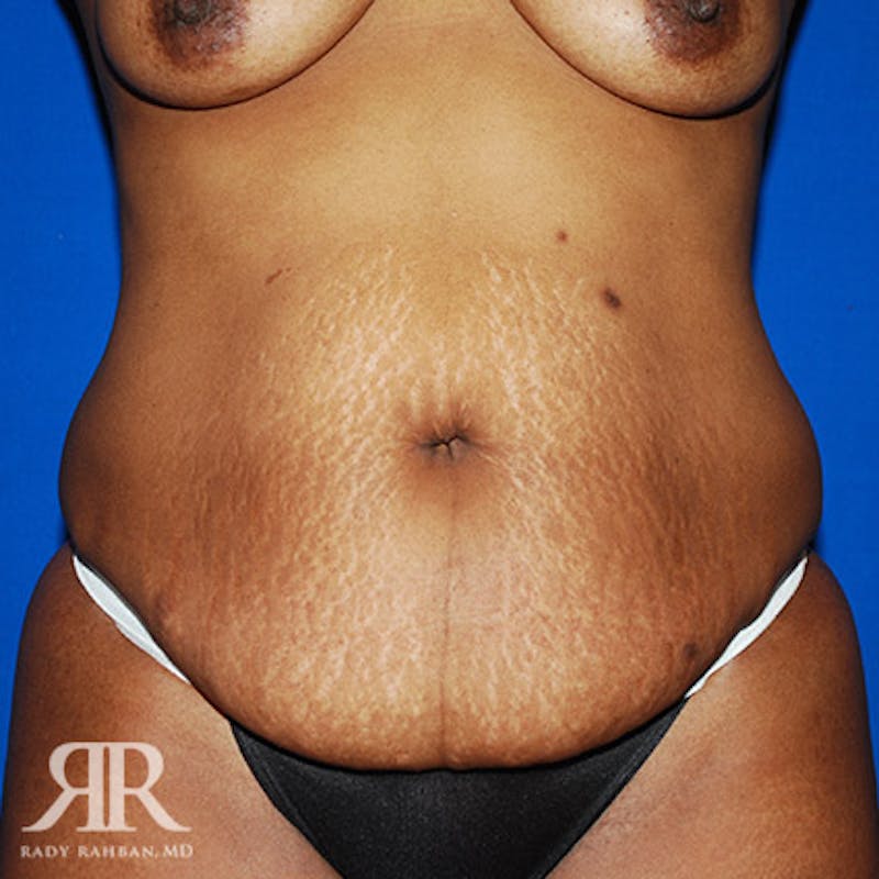 Tummy Tuck Before & After Gallery - Patient 329384 - Image 1
