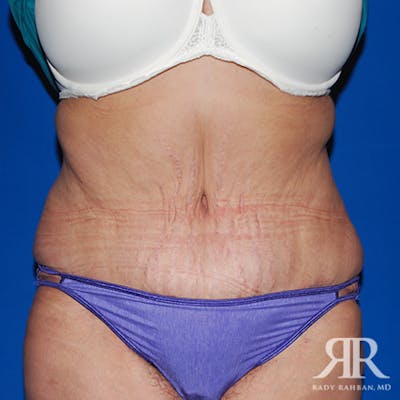 Tummy Tuck Before & After Gallery - Patient 422397 - Image 2