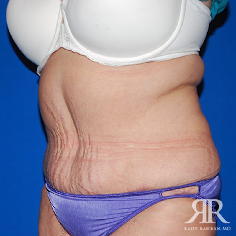 Tummy Tuck Before & After Gallery - Patient 422397 - Image 4