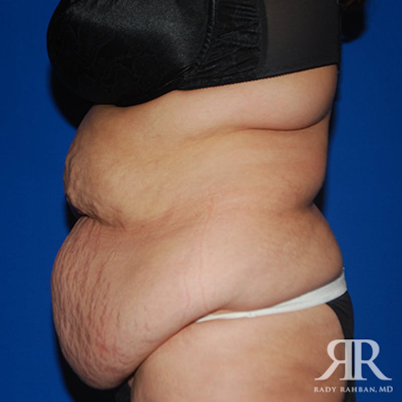 Tummy Tuck Before & After Gallery - Patient 422397 - Image 5