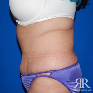 Tummy Tuck Before & After Gallery - Patient 422397 - Image 6