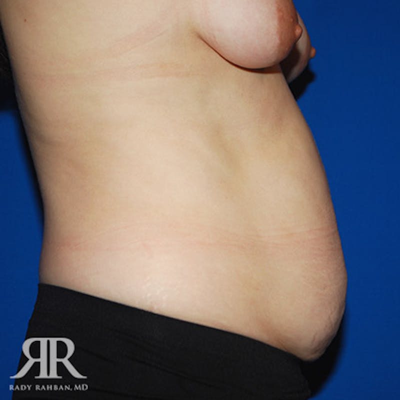 Tummy Tuck Before & After Gallery - Patient 356856 - Image 5